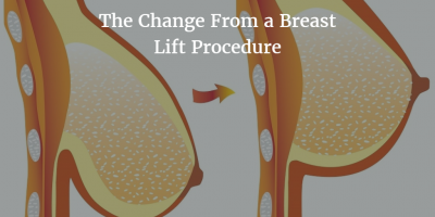 Breast uplift (mastopexy or breast lift)
