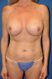 Following nipple-sparing mastectomies and full projection cohesive gel implant reconstructions using cosmetic breast lift-type incisions