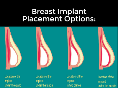 Breast Augmentation Surgery